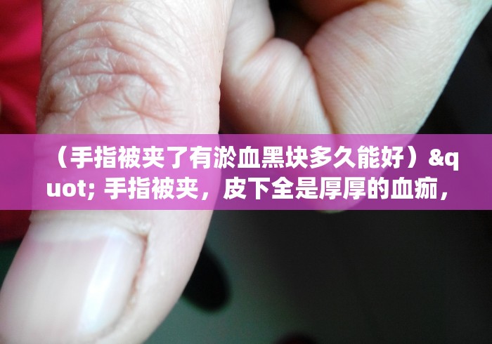 （手指被夹了有淤血黑块多久能好）" 手指被夹，皮下全是厚厚的血痂，这能长好吗